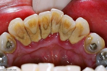 أسباب نزيف اللثّة أثناء تنظيف الأسنان