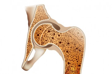 دراسة: بعض العقاقير المعالجة لهشاشة العظام قد تسبب كسوراً