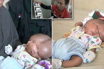 طفل ذو وجهين يولد في إندونيسيا