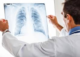 Lungs Cancer 1