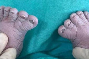 Baby With 12 Fingers